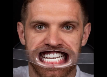 лечение зубов в Турции